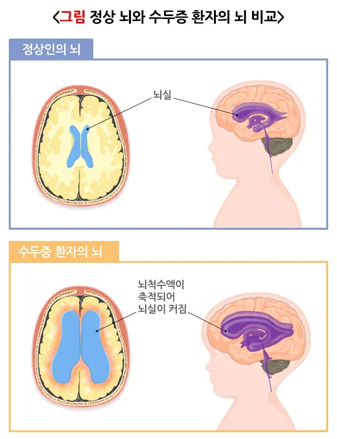 수두증(소아) 병태생리 설명 이미지 1