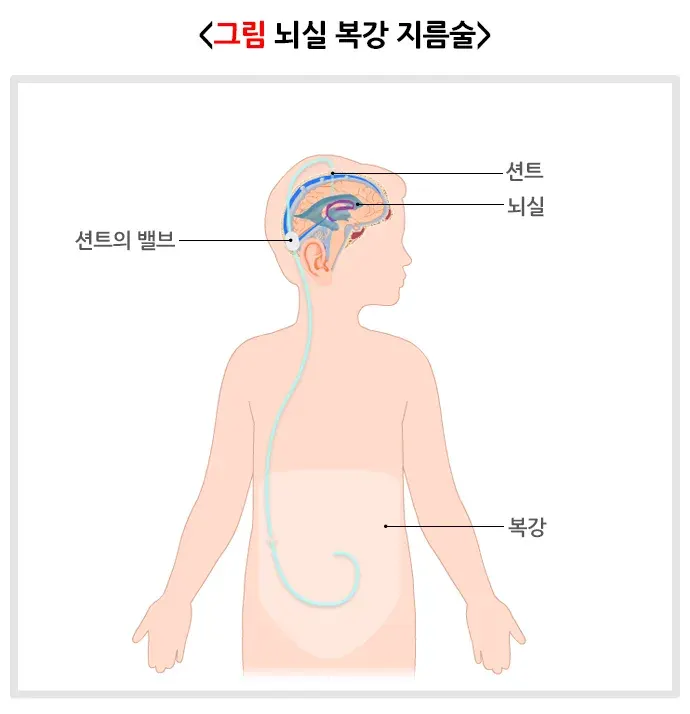 수두증(소아) 비약물 치료 설명 이미지 1
