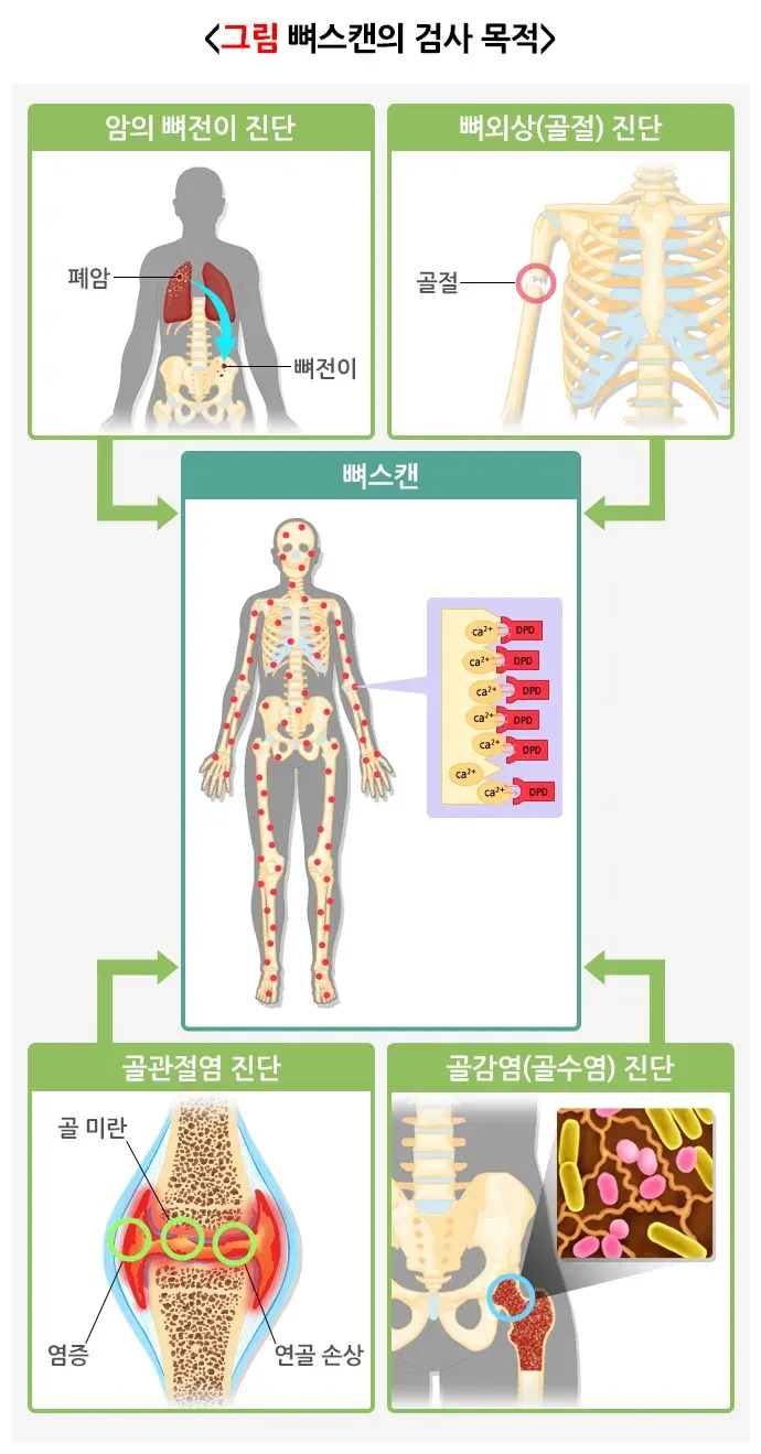 뼈스캔 검사 목적 설명 이미지 1