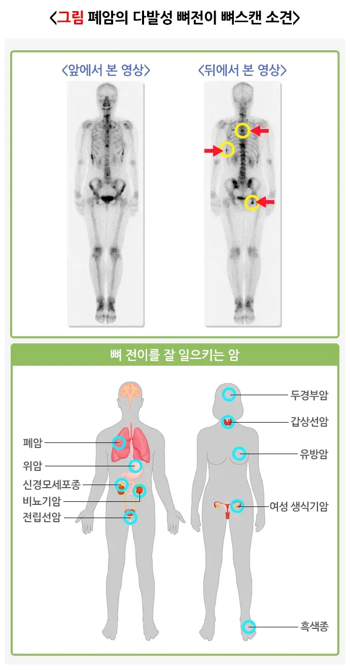 뼈스캔 검사 결과 해석 설명 이미지 1
