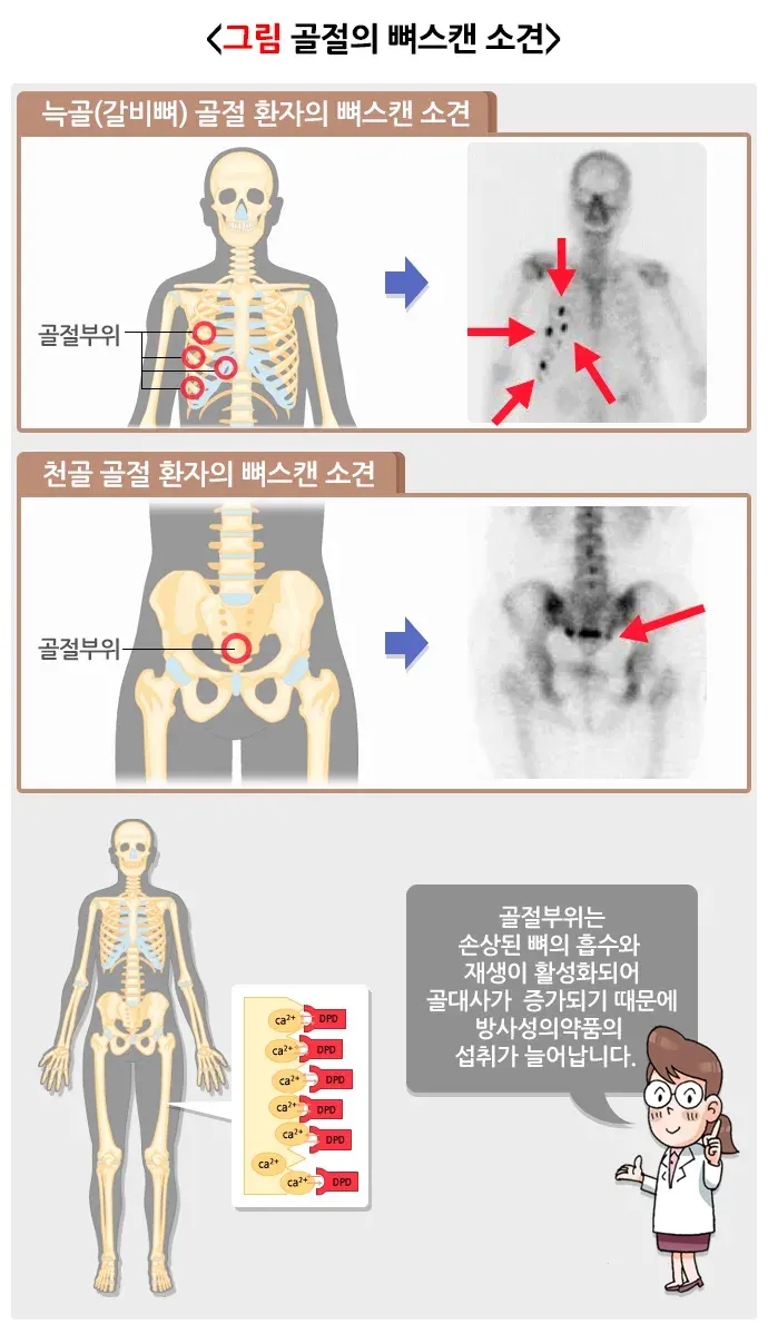 뼈스캔 검사 결과 해석 설명 이미지 2