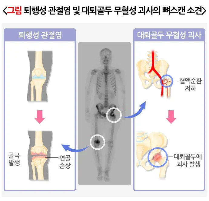뼈스캔 검사 결과 해석 설명 이미지 3