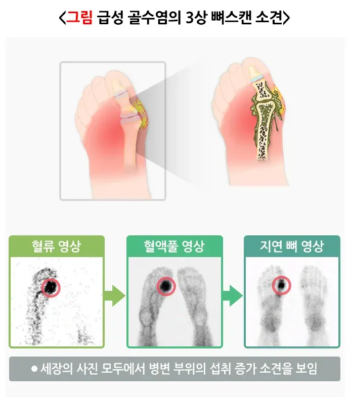 뼈스캔 검사 결과 해석 설명 이미지 4