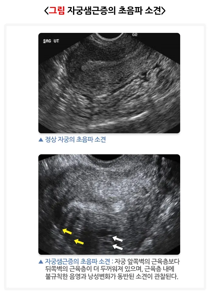 자궁샘근증 진단 및 검사 설명 이미지 1
