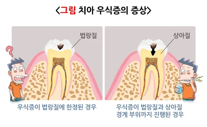 충치 증상 설명 이미지 1