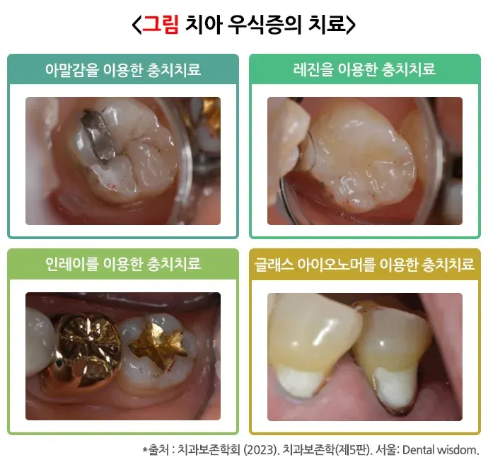 충치 비약물 치료 설명 이미지 1