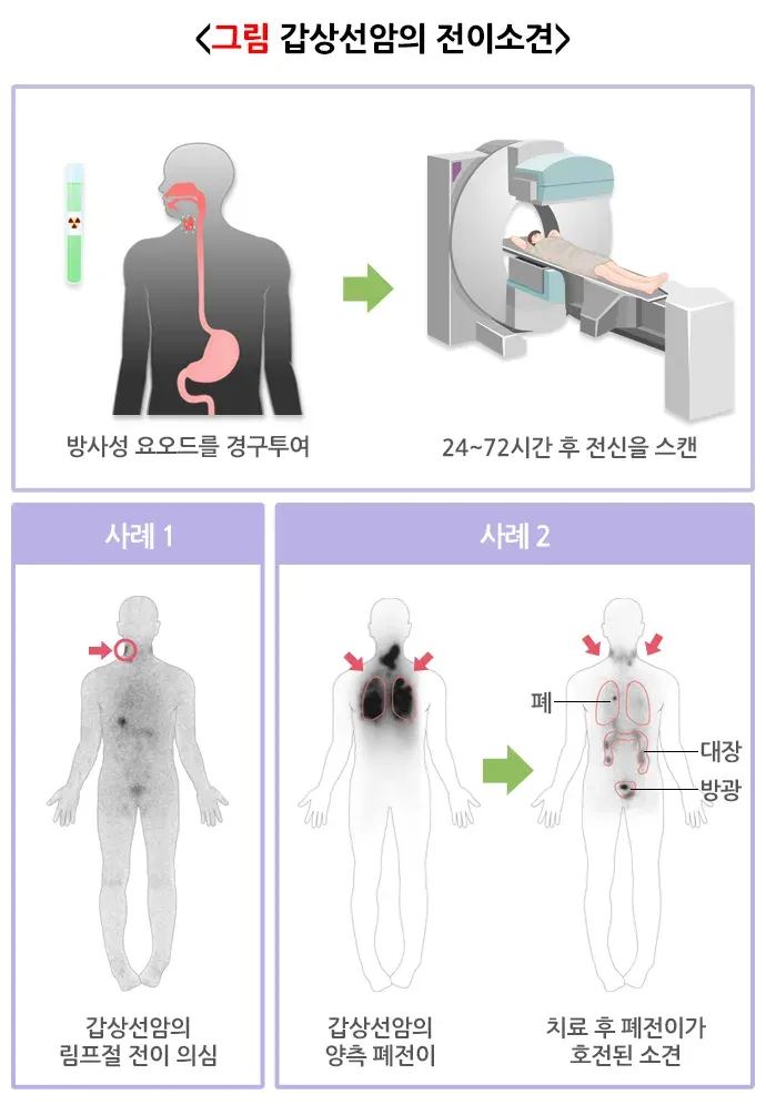 갑상선스캔 검사 결과 해석 설명 이미지 4