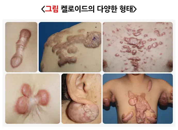 켈로이드 증상 설명 이미지 1