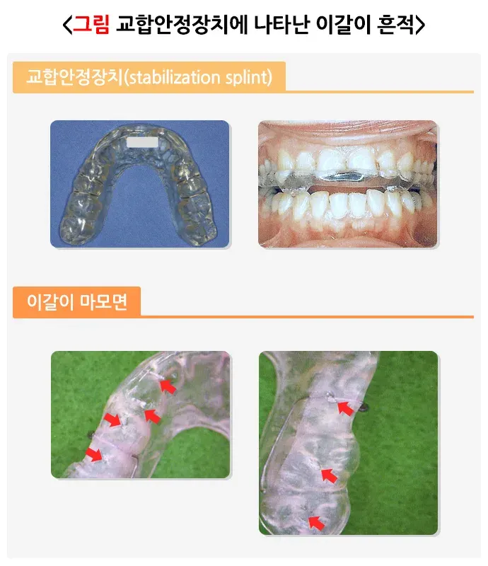 이갈이 진단 및 검사 설명 이미지 3