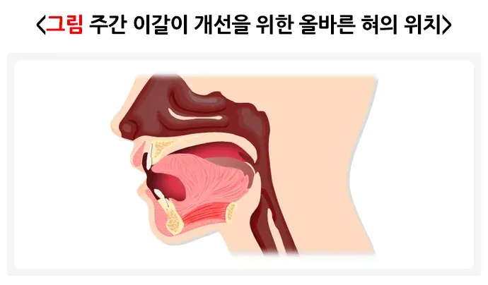 이갈이 비약물 치료 설명 이미지 2