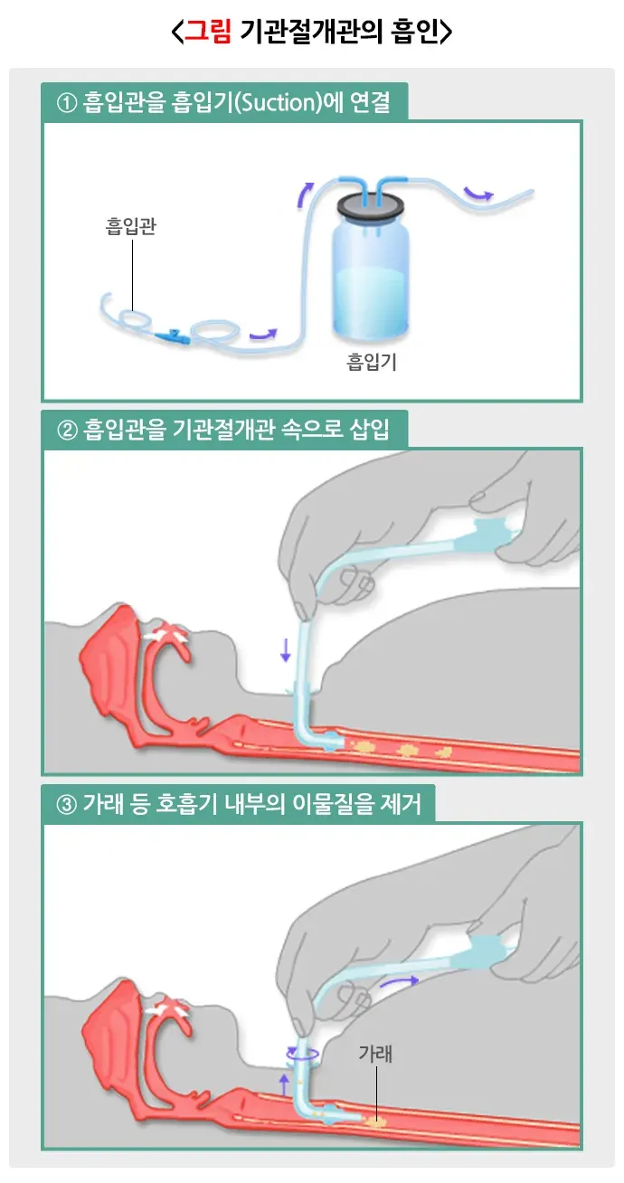 기관절개술 치료 후 관리 설명 이미지 2