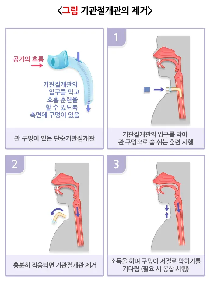 기관절개술 치료 후 관리 설명 이미지 4