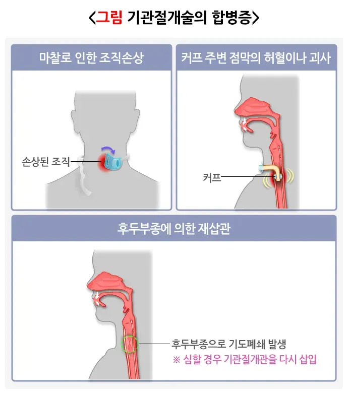 기관절개술 치료 관련 합병증 및 부작용 설명 이미지 1