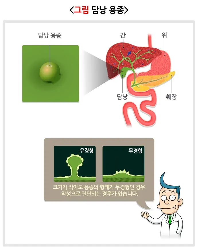 담낭 용종 종류 설명 이미지 1