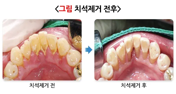 구강병 예방 및 관리방법! 알려드리겠습니다! 맞춤형 실천 방법 설명 이미지 2