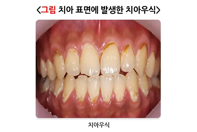 구강병 예방 및 관리방법! 알려드리겠습니다! 종류 설명 이미지 1