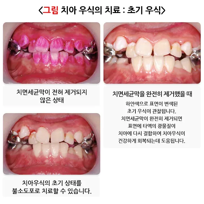 구강병 예방 및 관리방법! 알려드리겠습니다! 종류 설명 이미지 3