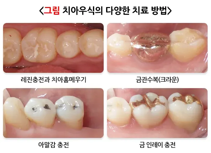 구강병 예방 및 관리방법! 알려드리겠습니다! 종류 설명 이미지 4