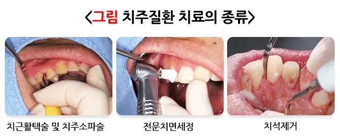 구강병 예방 및 관리방법! 알려드리겠습니다! 종류 설명 이미지 7