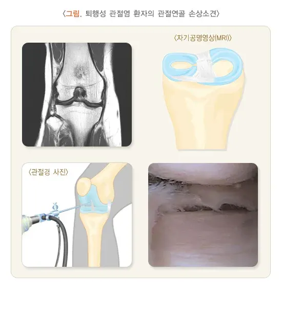 골관절염 진단 및 검사 설명 이미지 2