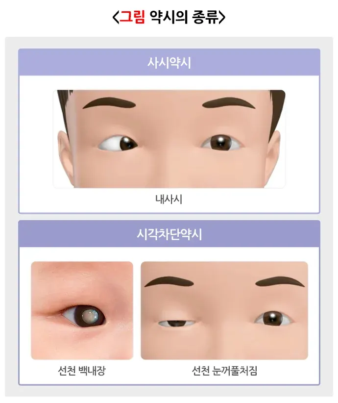 약시(소아) 원인 설명 이미지 1