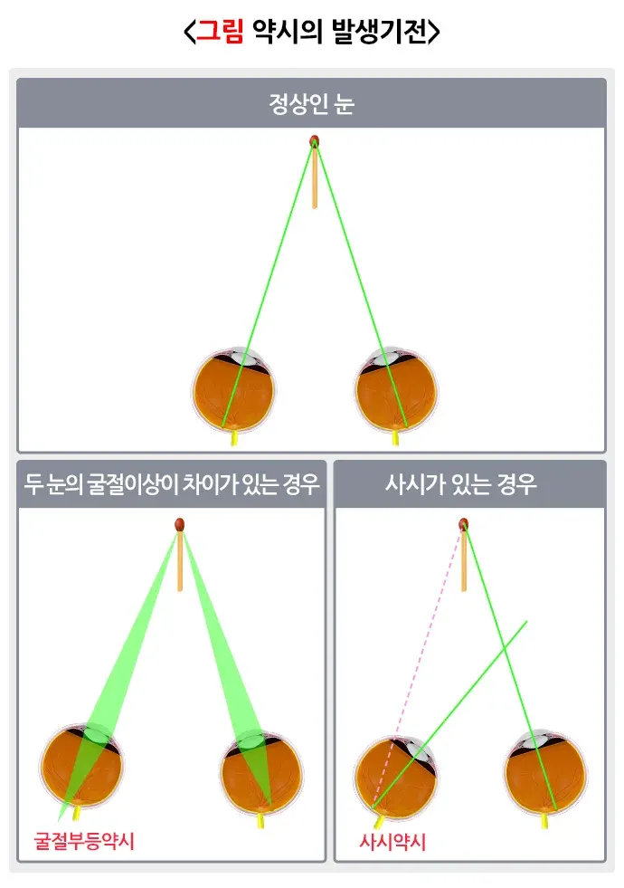 약시(소아) 병태생리 설명 이미지 1