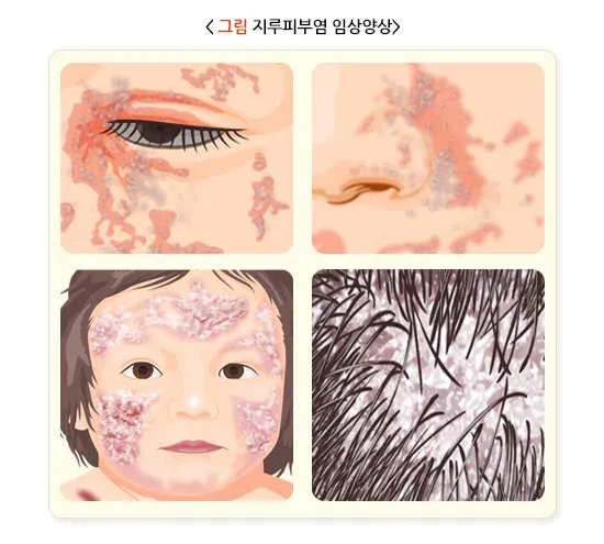 지루 피부염 증상 설명 이미지 1