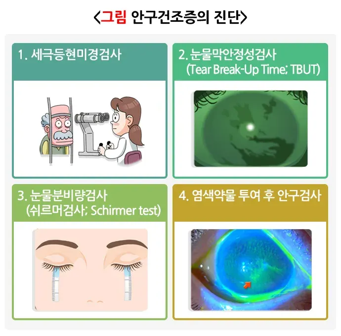 안구건조증 진단 및 검사 설명 이미지 1
