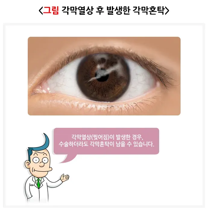 각막혼탁 및 반흔 원인 설명 이미지 3