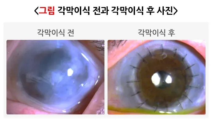 각막혼탁 및 반흔 비약물 치료 설명 이미지 1