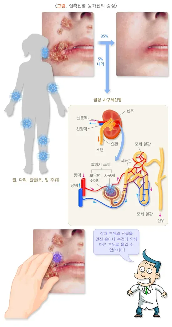 농가진 증상 설명 이미지 1