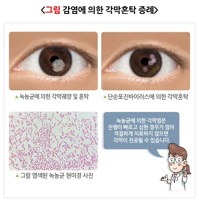 각막혼탁 및 반흔 원인 설명 이미지 1