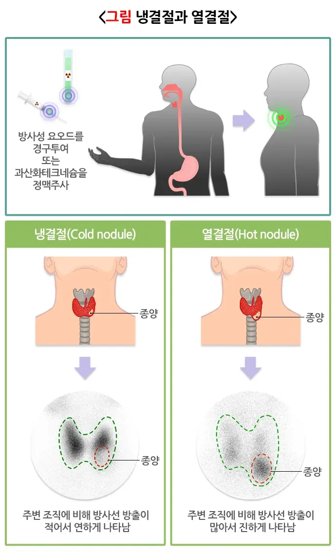 갑상선스캔 검사 결과 해석 설명 이미지 2