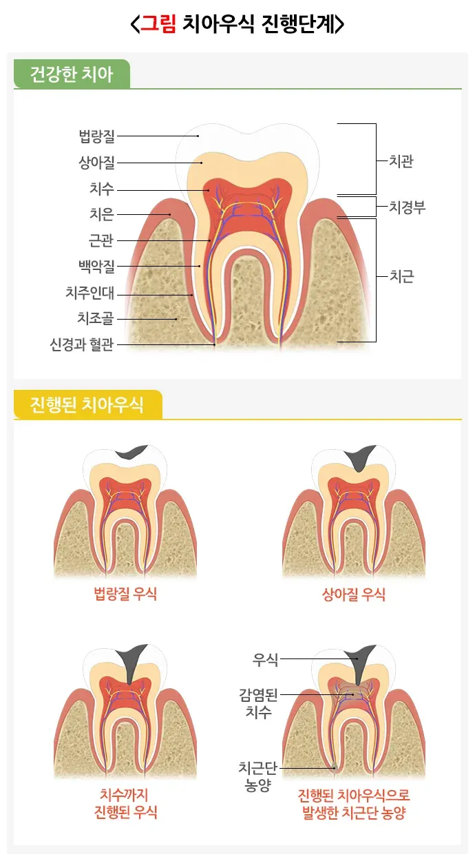 구강병 예방 및 관리방법! 알려드리겠습니다! 종류 설명 이미지 2