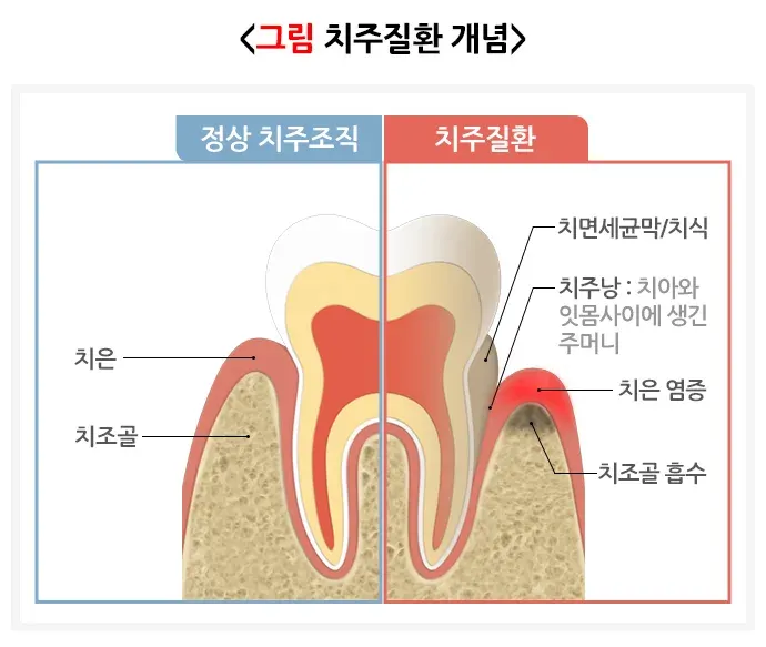 구강병 예방 및 관리방법! 알려드리겠습니다! 종류 설명 이미지 5