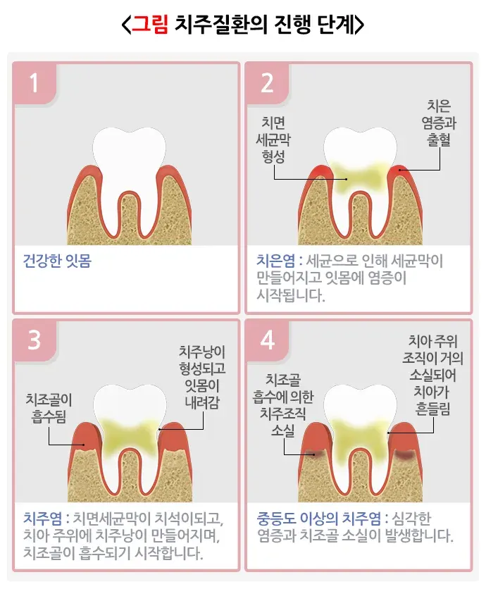 구강병 예방 및 관리방법! 알려드리겠습니다! 종류 설명 이미지 6