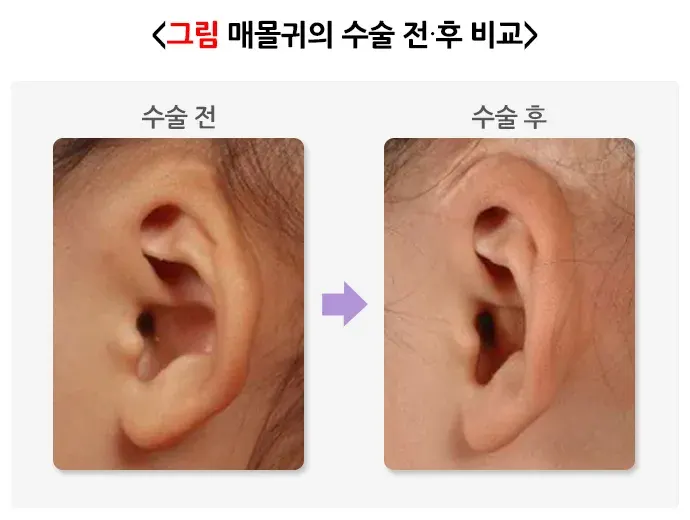 귀의 형태 이상(기타) 종류 설명 이미지 2