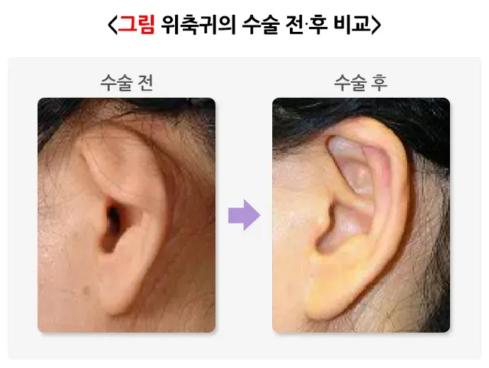 귀의 형태 이상(기타) 종류 설명 이미지 3