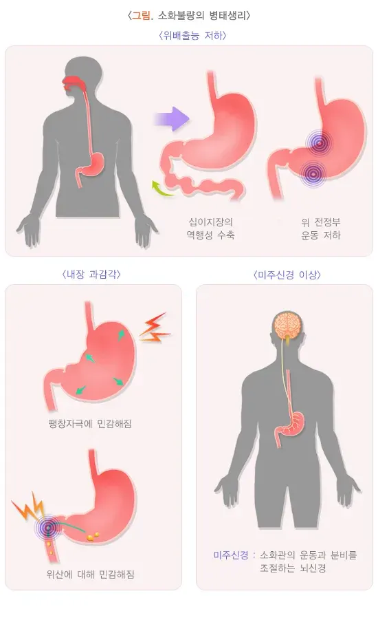 소화불량 병태생리 설명 이미지 1