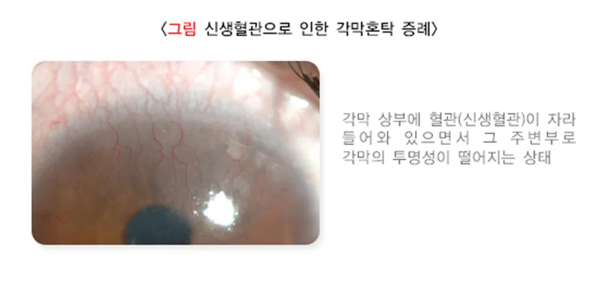 각막혼탁 및 반흔 원인 설명 이미지 5
