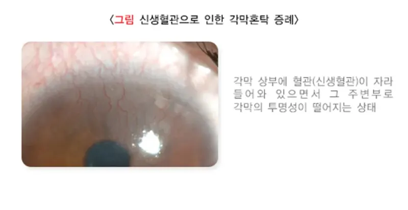 각막혼탁 및 반흔 원인 설명 이미지 5