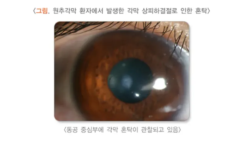 각막혼탁 및 반흔 원인 설명 이미지 4