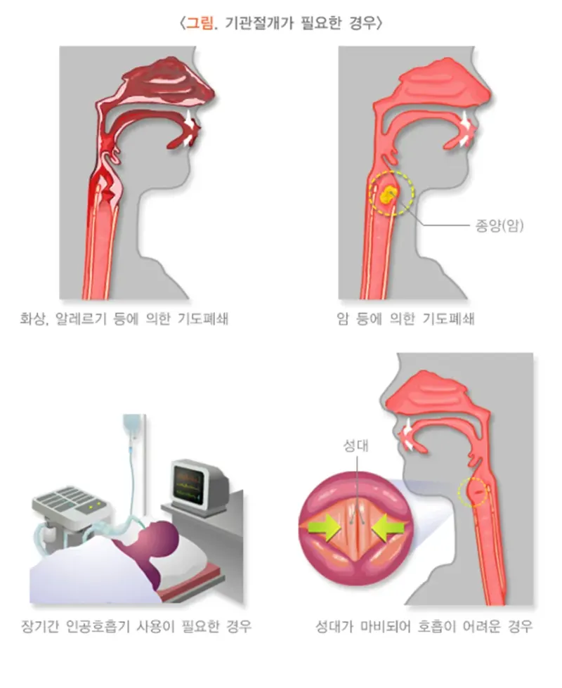 기관절개술 치료의 적응증 설명 이미지 1