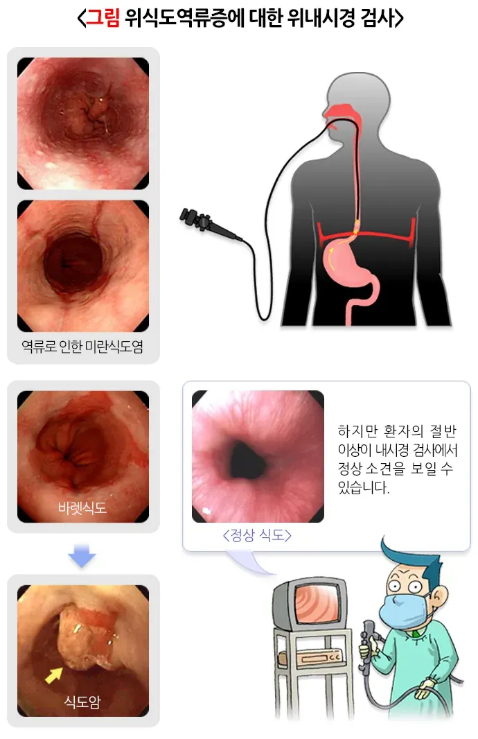 위식도역류질환 진단 및 검사 설명 이미지 1