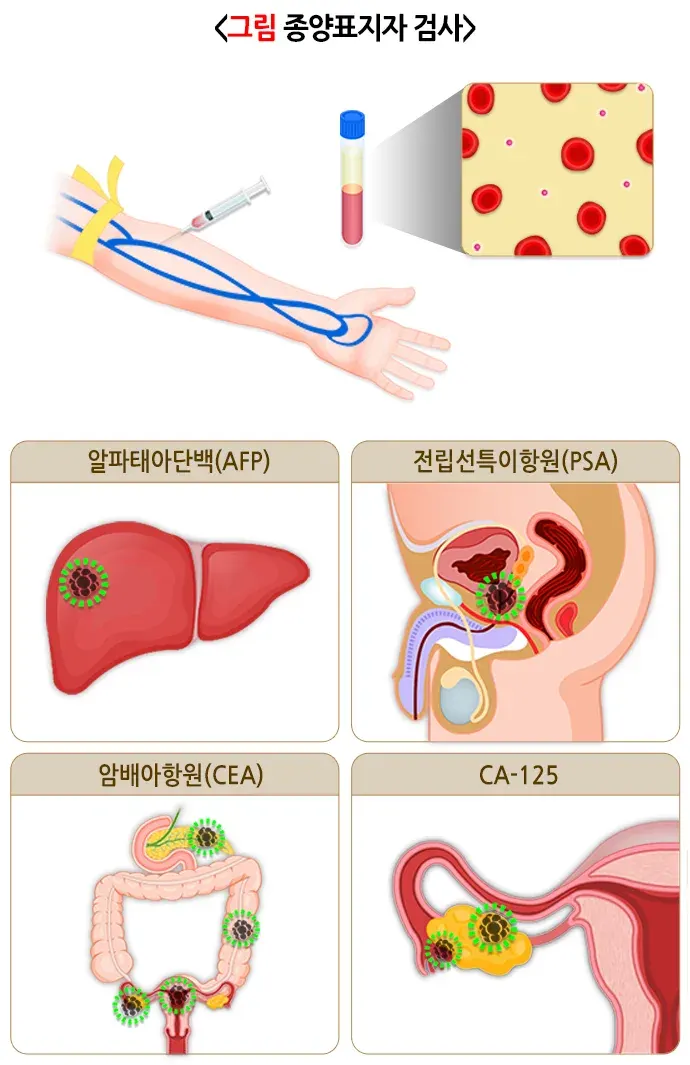 종양표지자 검사 검사 결과 해석 설명 이미지 1