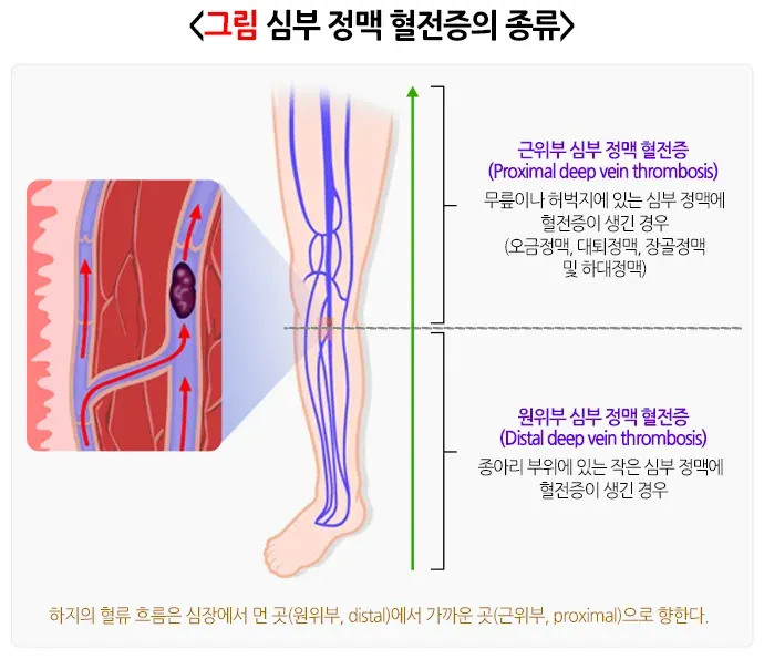 심부 정맥 혈전증 종류 설명 이미지 1