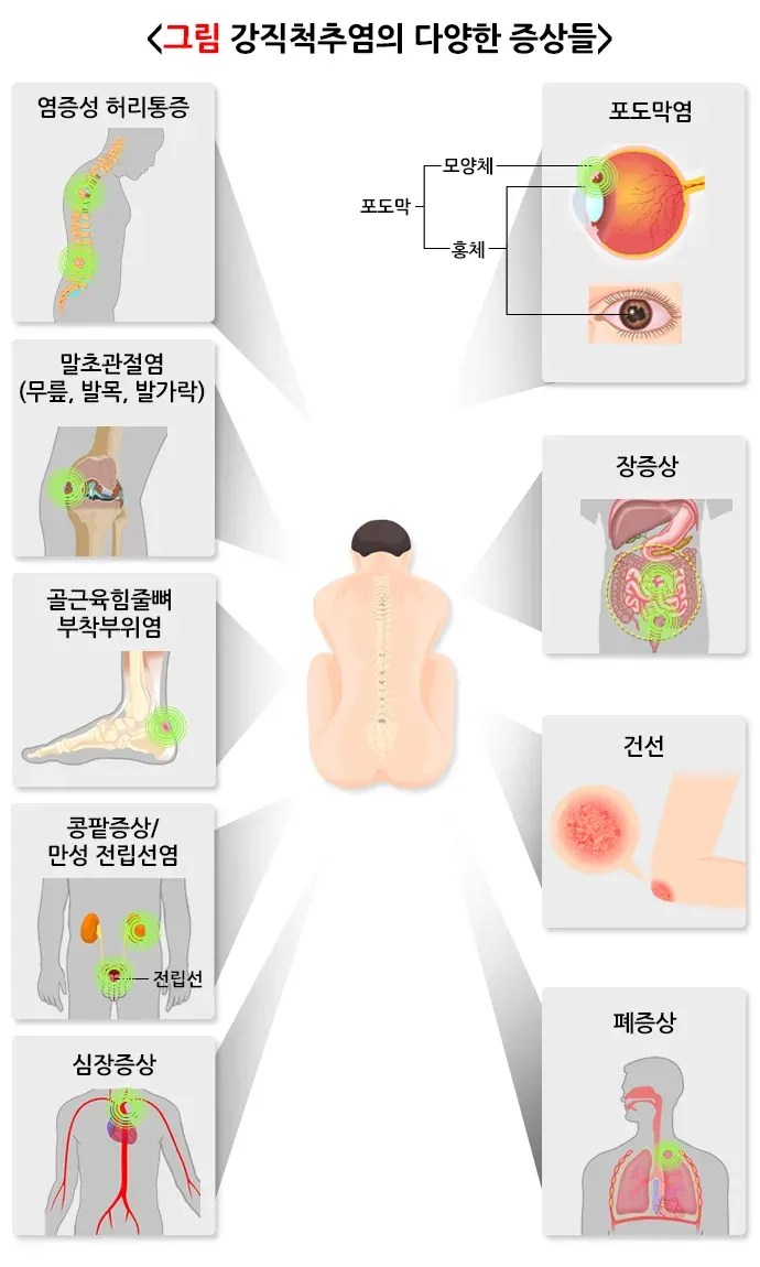 강직척추염 증상 설명 이미지 2