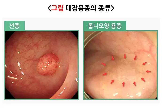 대장용종 종류 설명 이미지 1