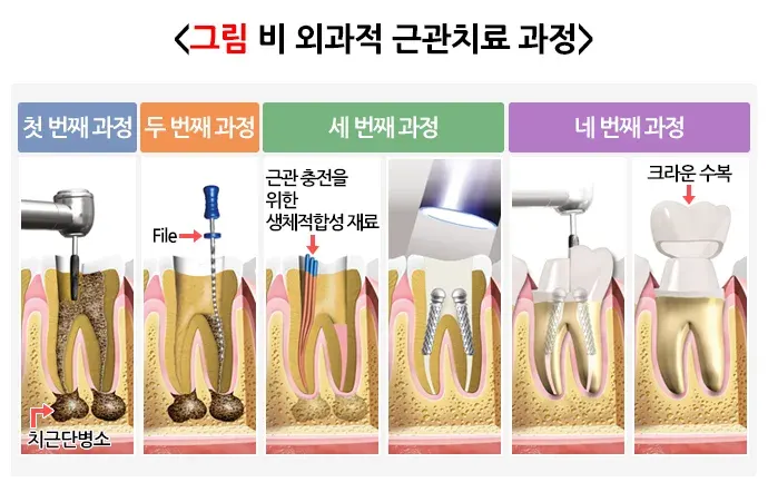 근관치료 치료 방법 설명 이미지 1