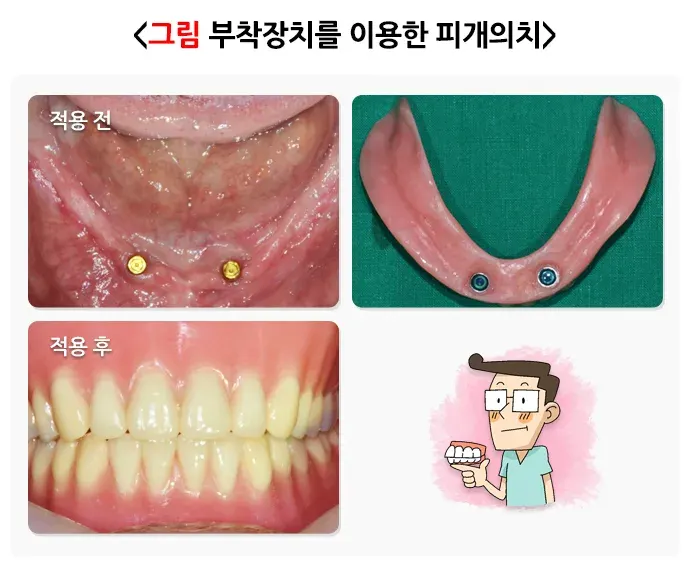 가철성 보철 치료 방법 설명 이미지 3